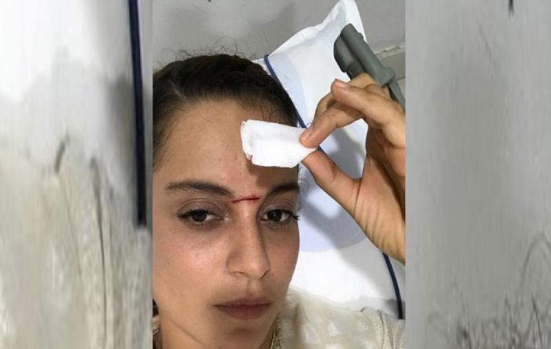 शूटिंग के दौरान कंगना रनौत के माथे पर लगी तलवार, अस्पताल में भर्ती