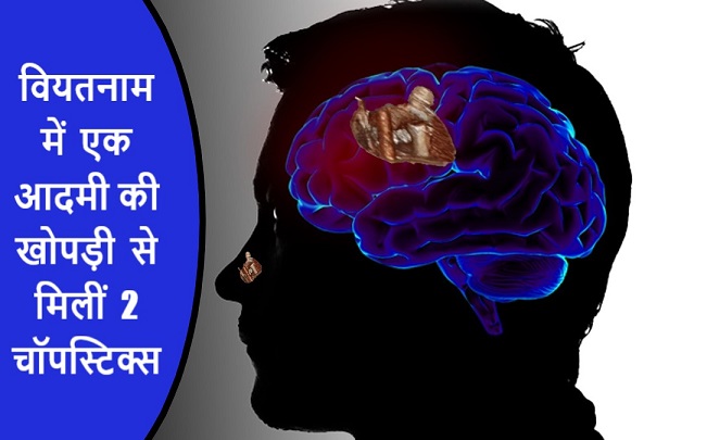 वियतनाम में एक आदमी की खोपड़ी से मिलीं 2 चॉपस्टिक्स